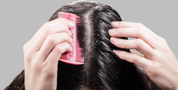 is seborrheic dermatitis contagious